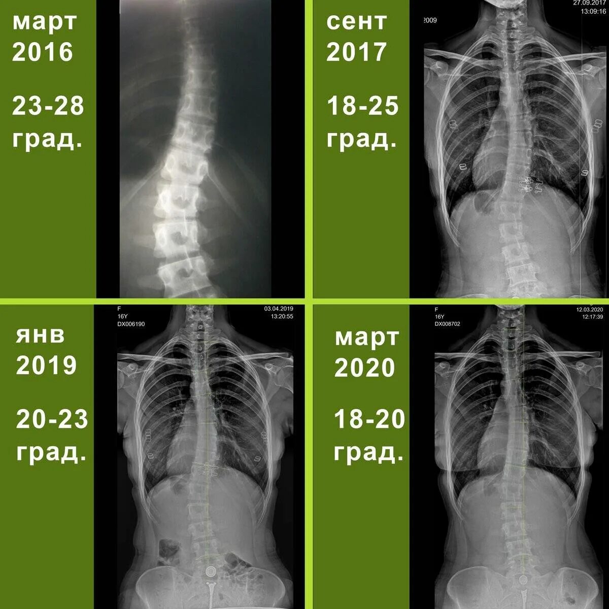 Сколиоз 25 градусов рентген. Сколиоз 26 градусов рентген. Сколиоз 17 градусов рентген. Сколиоз угол искривления 17 градусов.