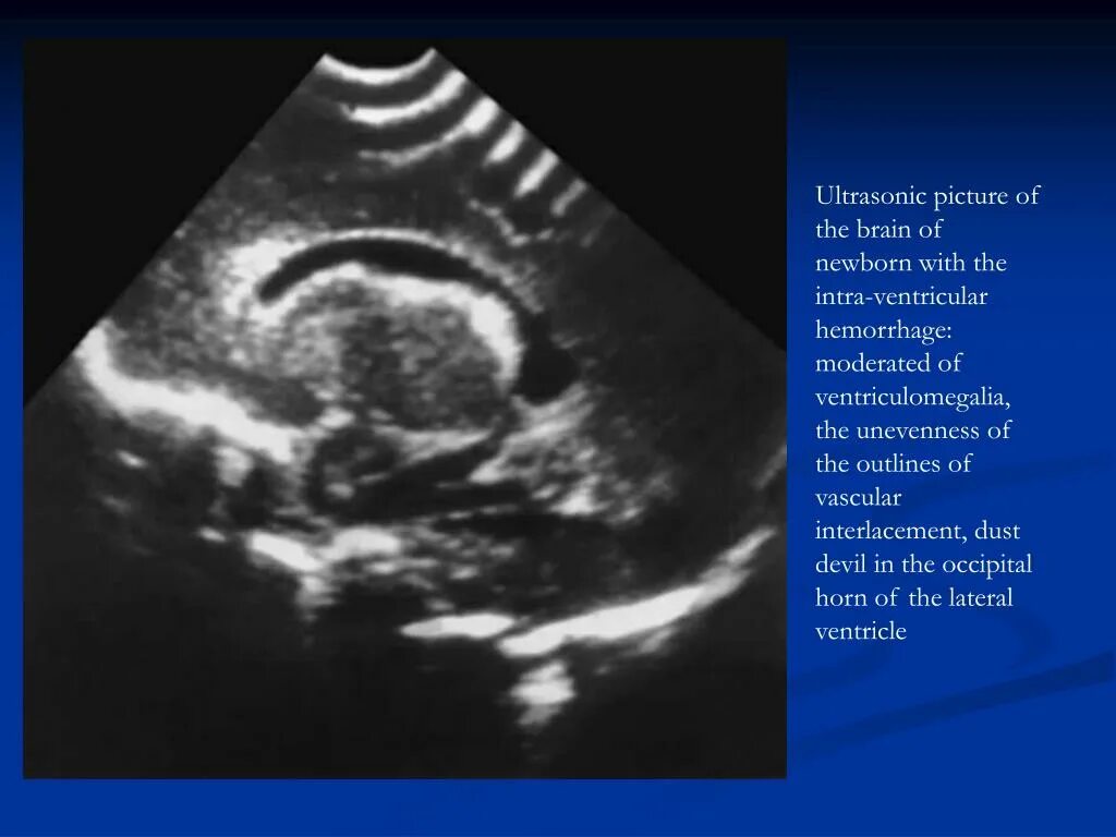 У плода киста мозга сплетения. УЗИ головного мозга нейросонография. Ультразвуковая анатомия головного мозга новорожденных. Анатомия головного мозга плода на УЗИ. Ультразвуковая картина мозга.