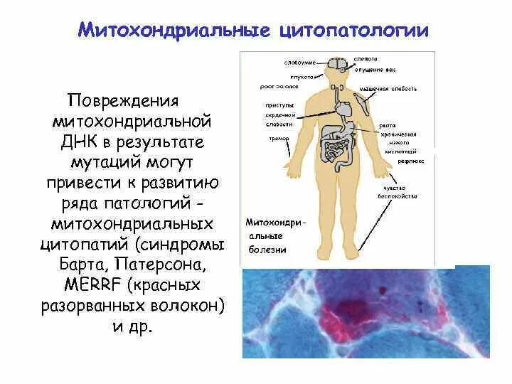 Митохондриальные болезни. Митохондриальные заболевания человека. Мутации в митохондриальной ДНК. Митохондриальные цитопатии. Синдром барта