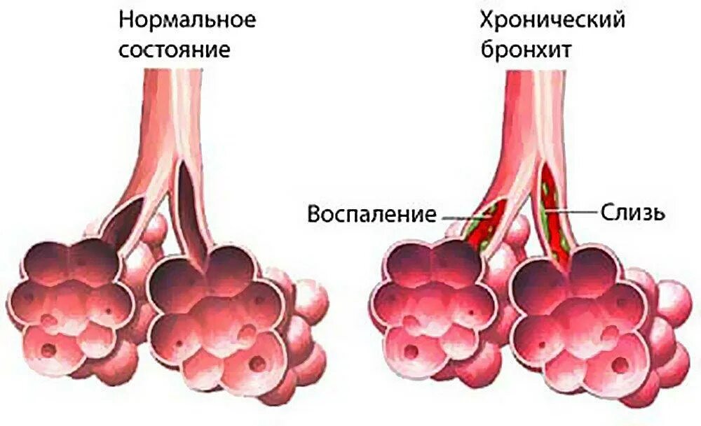 Мокрота в бронхах