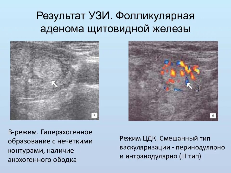 Очаговое образование в правой доле в. Аденома щитовидной железы дифференциальная диагностика. Аденоматозный узел щитовидной железы на УЗИ. Гиперэхогенный узел в щитовидной железе УЗИ. Аденома паращитовидной железы на УЗИ.