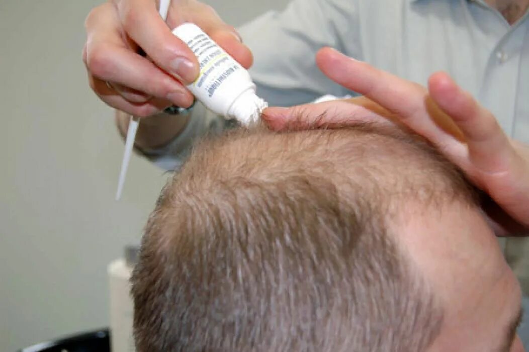 Выпадение волос у мужчин лечение. Андрогенная алопеция трихоскопия. Выпадение волос у мужчин. Микоз волосистой части головы.