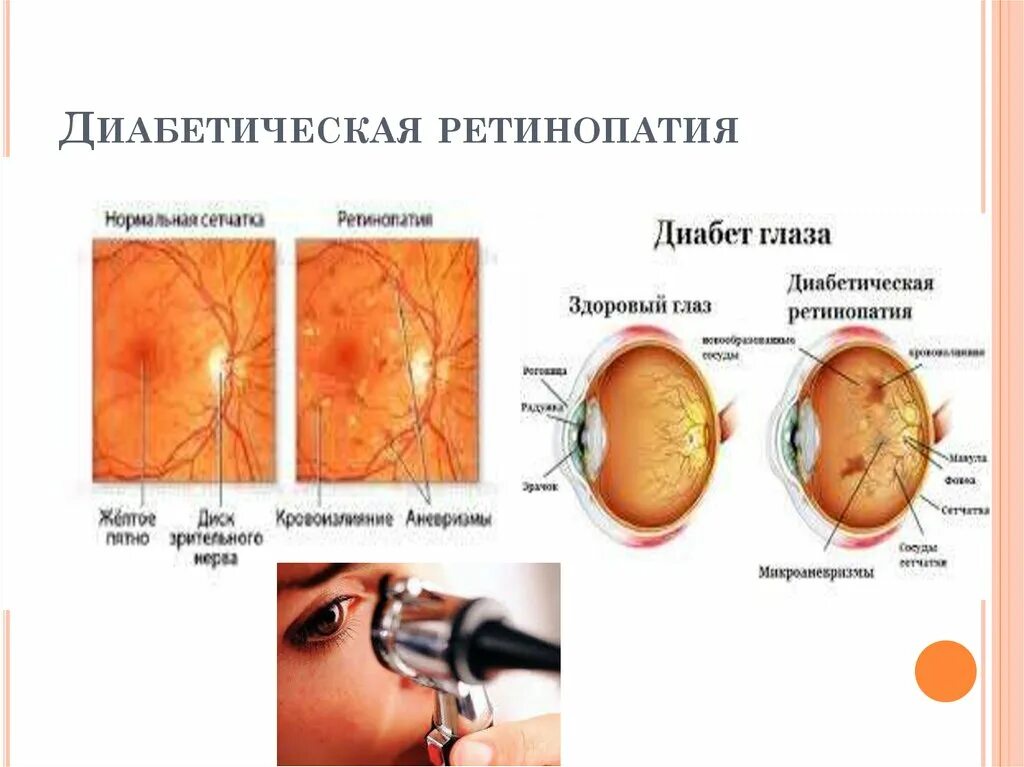 Сахарный диабет глаза ретинопатия. Диабетическая ретинопатия изменения глазного дна. Глазное дно при диабетической ретинопатии. Сахарный диабет и диабетическая ретинопатия.