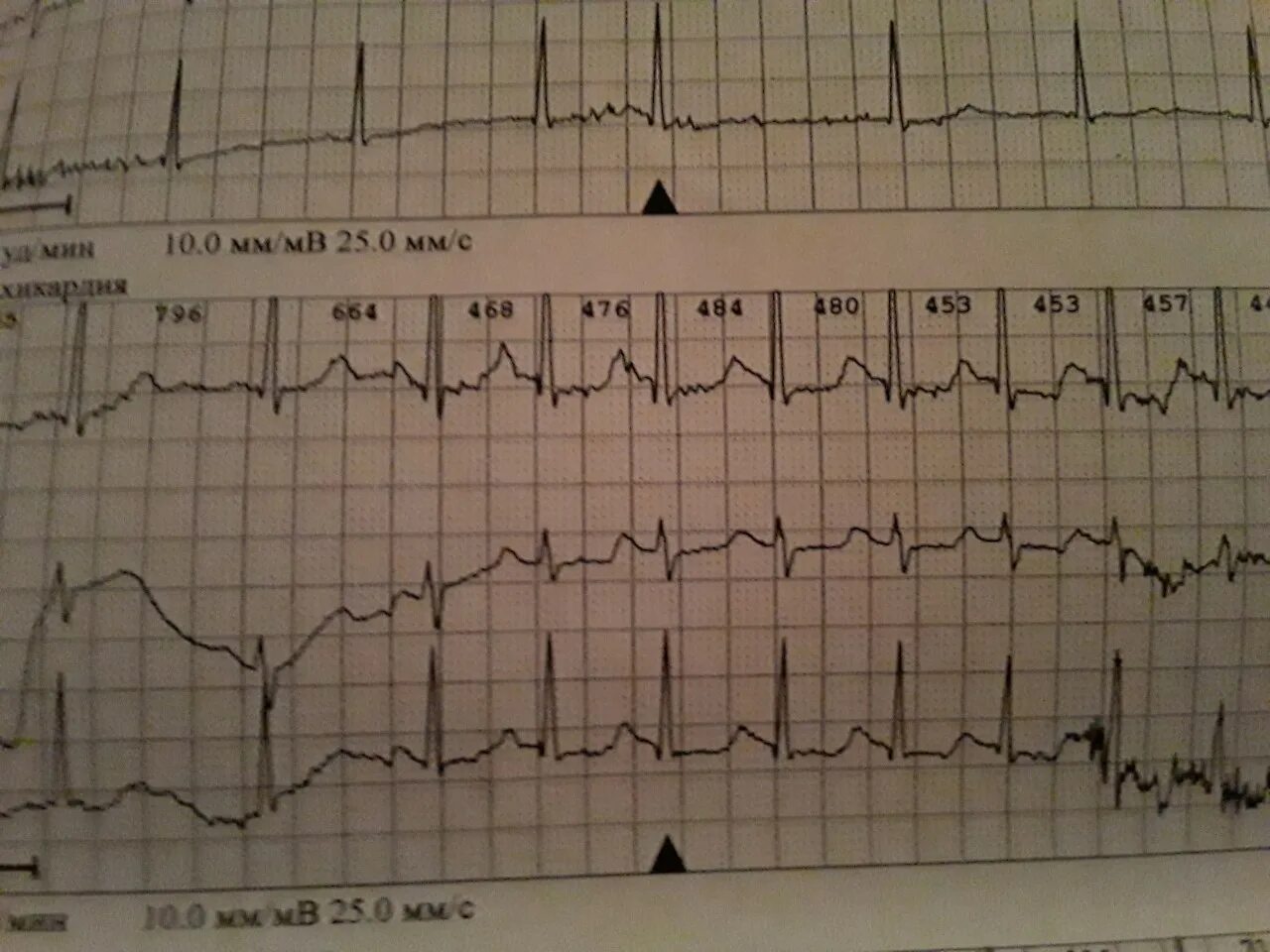 Тахисистолия это. Катехоламинергическая желудочковая тахикардия. Пробежка желудочковой тахикардии на ЭКГ. ЖТ на ЭКГ. Пробежка ЖТ на ЭКГ.
