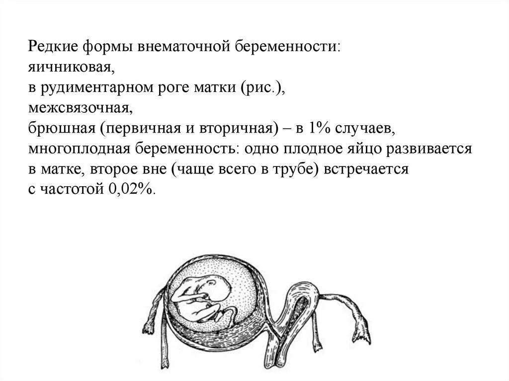 Размер плодного яйца при внематочной беременности. Внематочная беременность в рудиментарном Роге на УЗИ. Редкие формы внематочной беременности. Формы трубной беременности. Матка на 1 неделе беременности