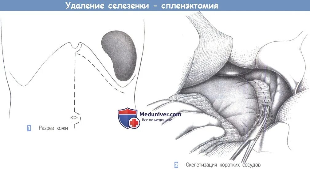 Спленэктомия что это. Этапы операции спленэктомии. Спленэктомия операция. Разрез при спленэктомии.