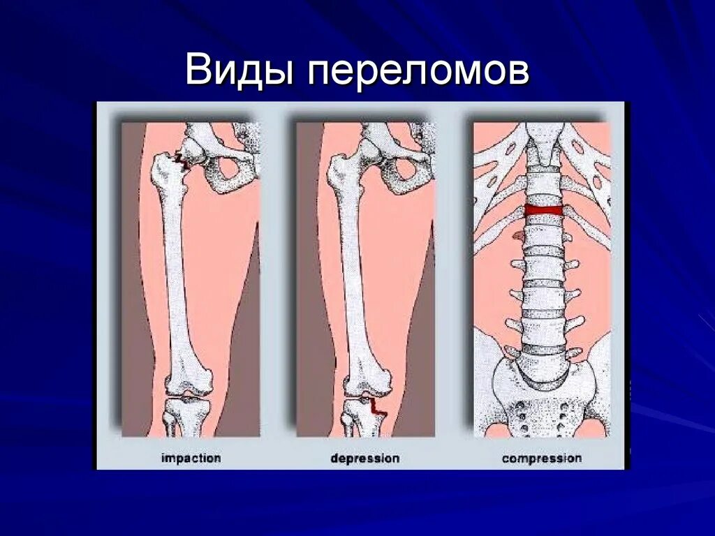 Степени открытого перелома. Простые и сложные переломы.