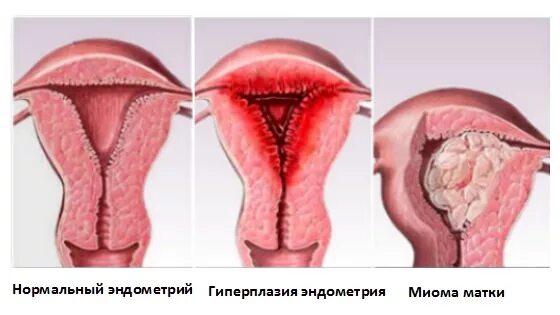 Слизистая матки отторгается. Полиповидная гиперплазия. АМК гиперплазия эндометрия. Патология эндометрия гиперплазия. Ультраменструальная гиперплазия эндометрия что это.