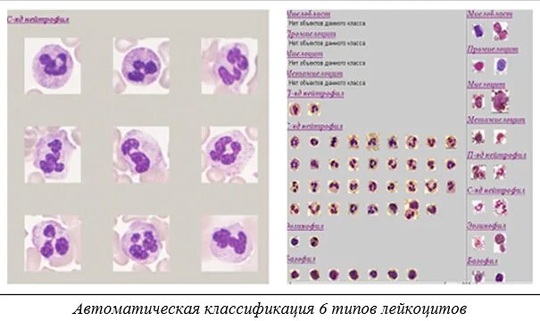 Следы лейкоцитарной эстеразы в моче у женщины. Следы лейкоцитарной эстеразы в моче у женщины