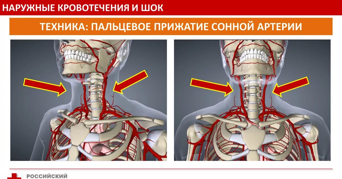 Помощь при ранении шеи. Сон артерия кровотечение. Кровотечение из сонной артерии.