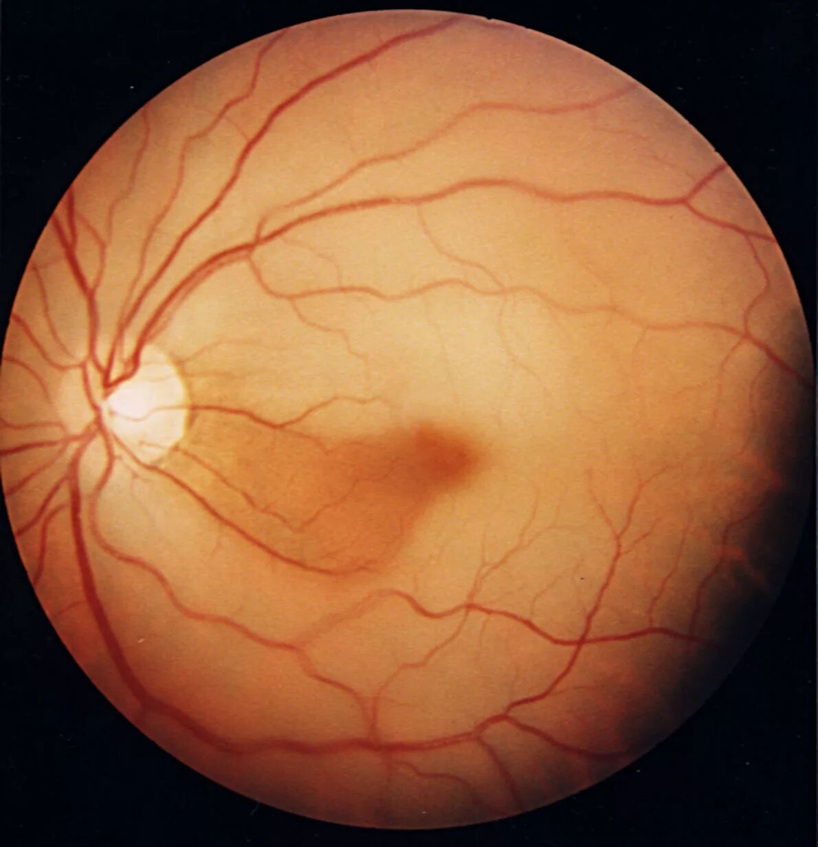 Миопический конус. Острая непроходимость центральной артерии сетчатки (цас).. Тромбоз сетчатки глазное дно.