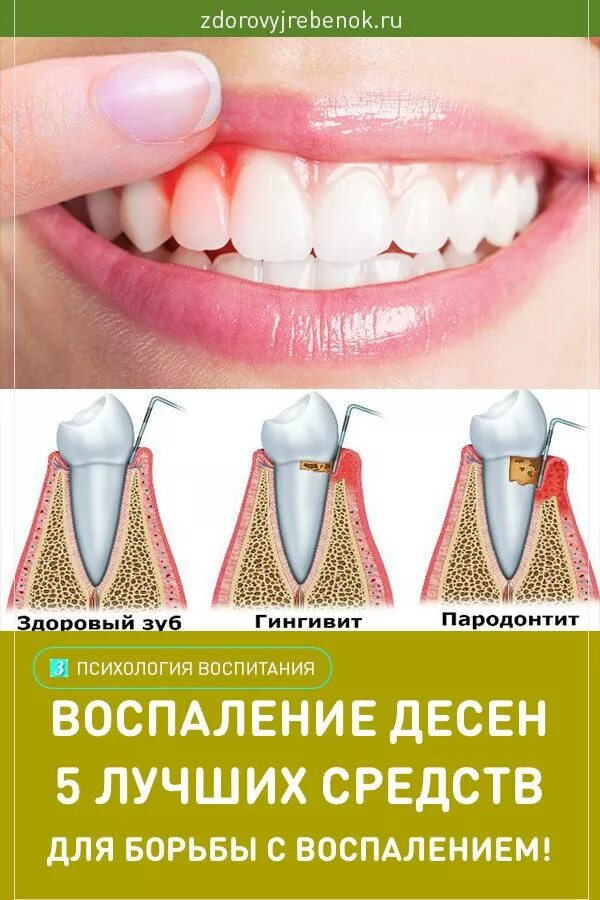 Лечение десен народными средствами в домашних условиях. Воспаление зубов и десен. Воспаление десен средства.