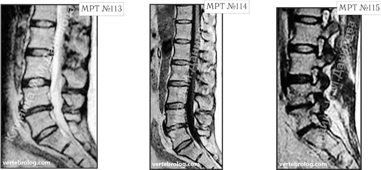 L4 l5 отдел позвоночника протрузия. Спондилез.спондилоартроз.протрузия диска l4-l5. Грыжи дисков l4-l5 l5-s1. Протрузия l2-3.