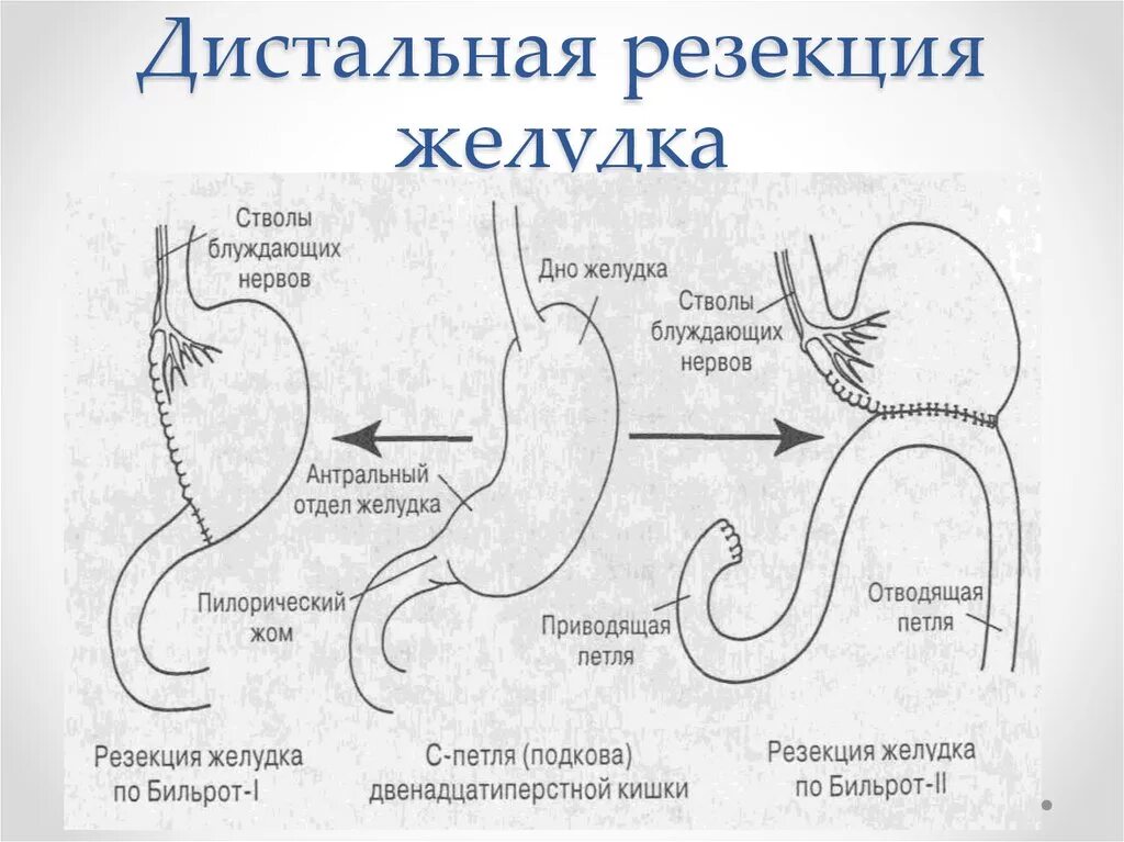 Удаление желудка полностью при раке. Операция резекция желудка по бильрот 2. дистальная резекция желудка по бильрот 1. субтотальная резекция желудка схема.