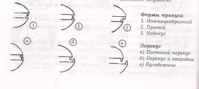 ножницеобразный прикус
