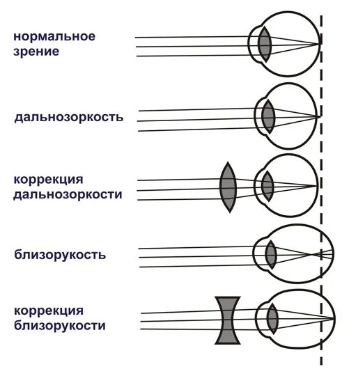 Ход лучей глаза человека. Схемы рефракции при нормальном зрении. Нарушения рефракции глаза близорукость дальнозоркость. Схема преломления лучей при нормальной рефракции. Близорукость и дальнозоркость схема рефракции.