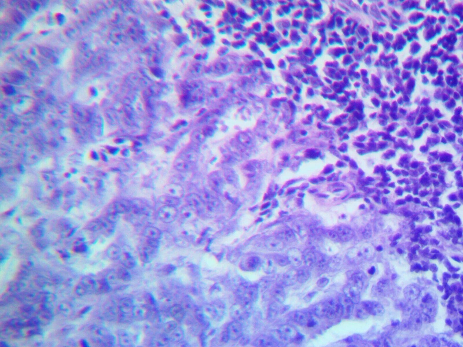 папиллярный рак молочной. папиллярная аденокарцинома щитовидной. папиллярная карцинома в6. папиллярный рак молочной. папиллярная карцинома молочной железы гистология.