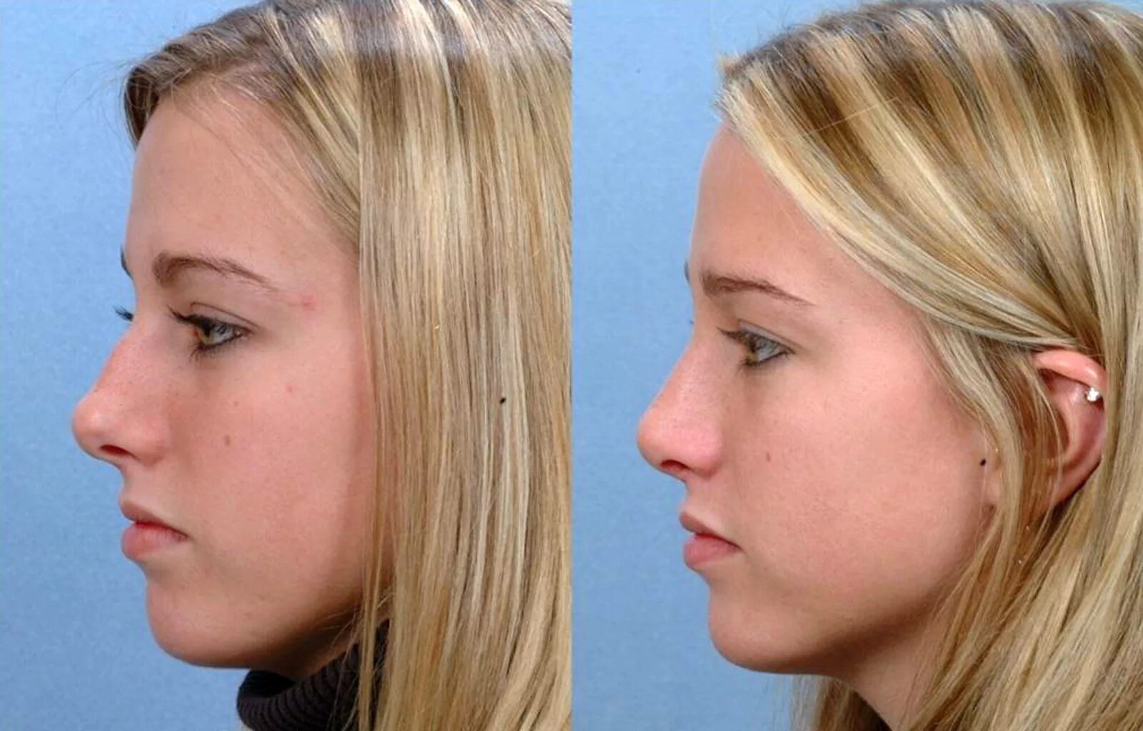 Ринопластика Эленшлегер. Пластика носа. Ринопластика носа. Пластическая операция на нос до и после. Фото ринопластики до и после нос