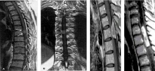 Интрамедуллярная опухоль спинного мозга мрт. Экстрадуральные опухоли спинного мозга. Интрамедуллярная киста спинного мозга. Интрамедуллярная опухоль спинного мозга шейного отдела позвоночника. Интрамедуллярные опухоли спинного
