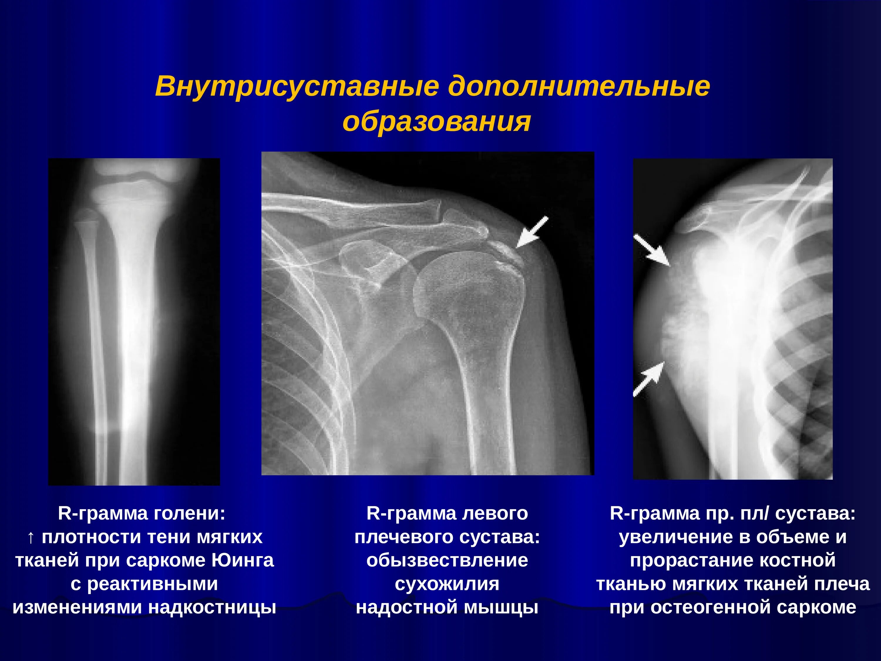 Обызвествление сухожилий мышц. Обызвествления плечевого сустава на рентгене. обызвествление связок плечевого сустава рентген. обызвествление в мягких тканях плечевого сустава на рентгене. анкилоз плечевого сустава рентген.