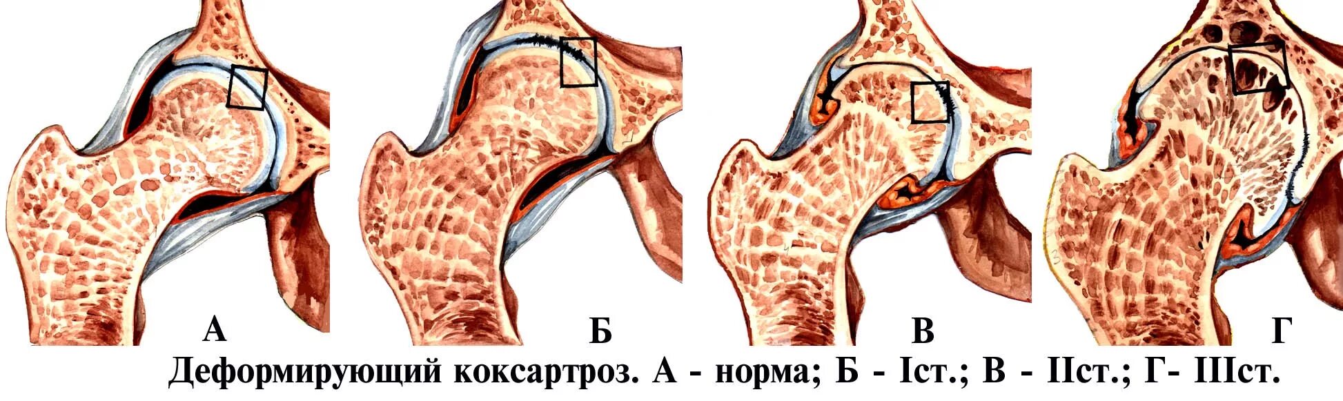 Лечение коксартроза тазобедренного сустава 1 2 степени. Деформирующий артроз тазобедренного сустава 1-2 степени. деформирующий артроз тазобедренного сустава. коксартроз (деформирующий артроз). деформирующий артроз тазобедренного сустава 2 степени.