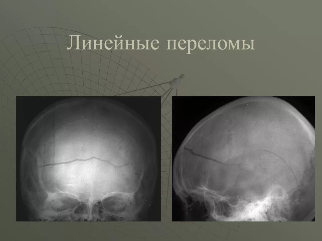 Перелом кости свода черепа. Перелом костей черепа рентген. Перелом костей свода черепа рентген. Перелом теменной кости черепа рентген. ЧМТ перелом свода черепа.