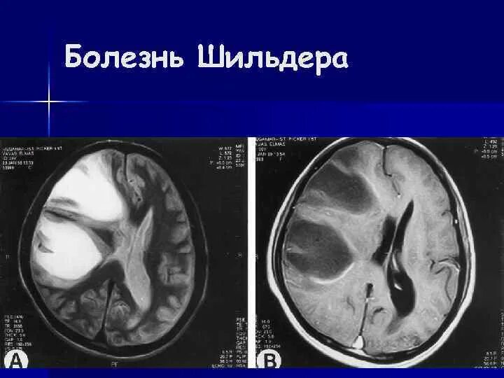 Лейкоэнцефалит. Энцефалит шильдера мрт. склероз шильдера. лейкоэнцефалит ван богарта. болезнь шильдера.
