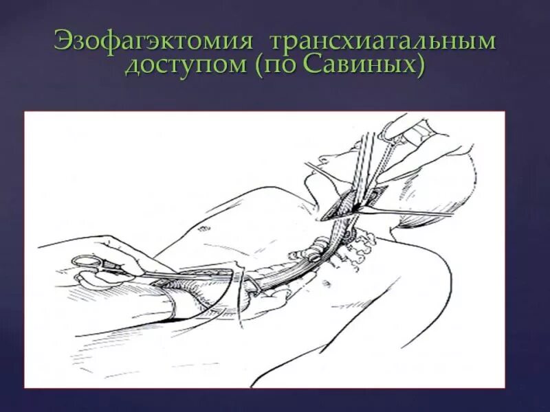 Операции на пищеводе. Трансхиатальная резекция пищевода.  Операция Льюиса -экстирпация пищевода. Операция Льюиса пищевод. Экстирпация пищевода с пластикой желудочной трубкой.