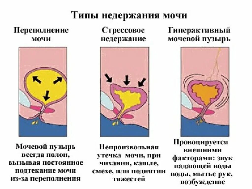 Непроизвольное Мочеиспускание У Женщин Во Время Секса
