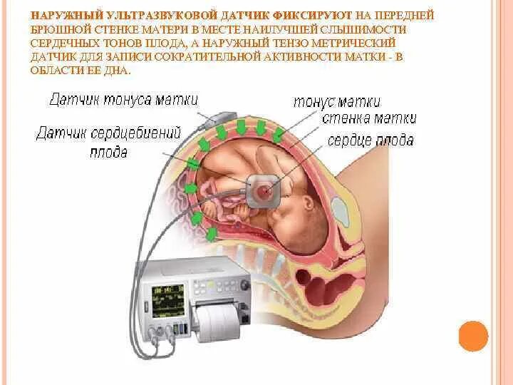 УЗИ при тонусе матки. Как отличить тонус