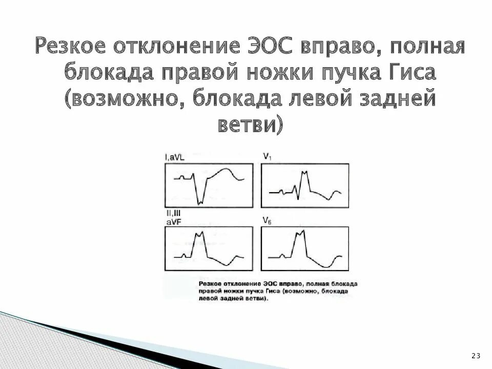 Отклонение оси сердца вправо. Двухпучковая блокада ножек пучка Гиса на ЭКГ. Отклонение ЭОС вправо, блокада задней ветви левой ножки пучка Гиса;. Блокада задней ветви левой ножки пучка. Сердце отклонено вправо