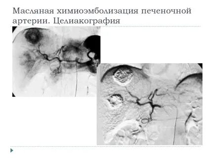 Химиоэмболизация печени отзывы
