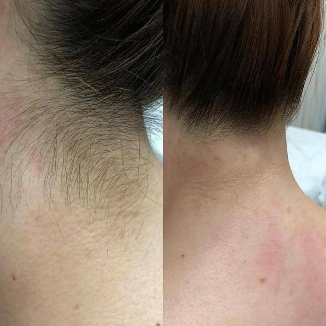 Когда начнут выпадать волосы после лазерной эпиляции. Лазерная эпиляция до и после. После лазерной эпиляции волосы не выпадают. Выпадают волосы после лазерной эпиляции. Волосы после лазерной эпиляции.