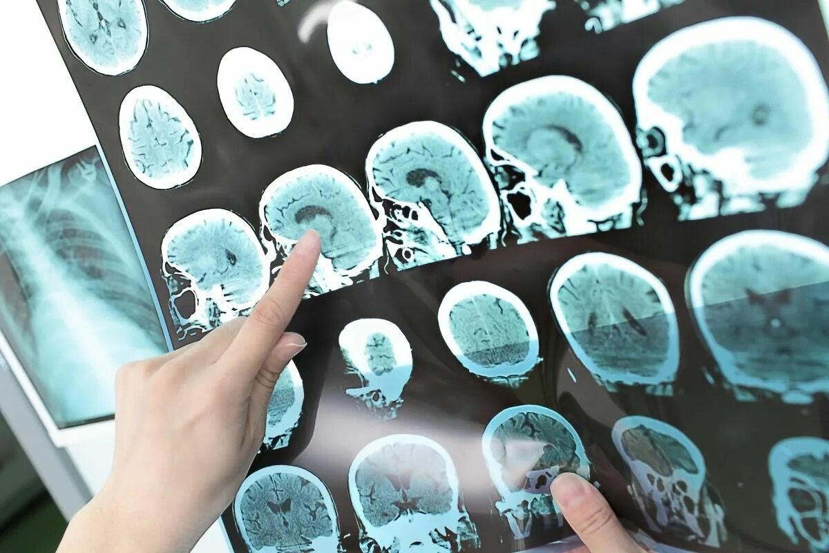 Исследование мозга. Снимки головного мозга с склерозом. Кт головного мозга при рассеянном склерозе. Рассеянный склероз мозг. Лечение рака головного мозга