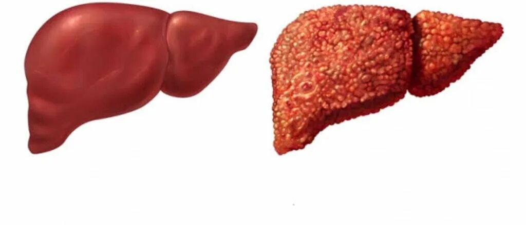 Гепатит сердце. Здоровая печень и цирроз печени. Печень здоровая и больная. Печень здорового человека и больного.