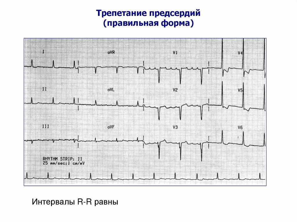 Правильная форма трепетания предсердий на ЭКГ. Формы фибрилляции предсердий ЭКГ. Трепетание предсердий 1 к 1 на ЭКГ. Трепетание предсердий 2 к 1 на ЭКГ. Формы трепетания предсердий