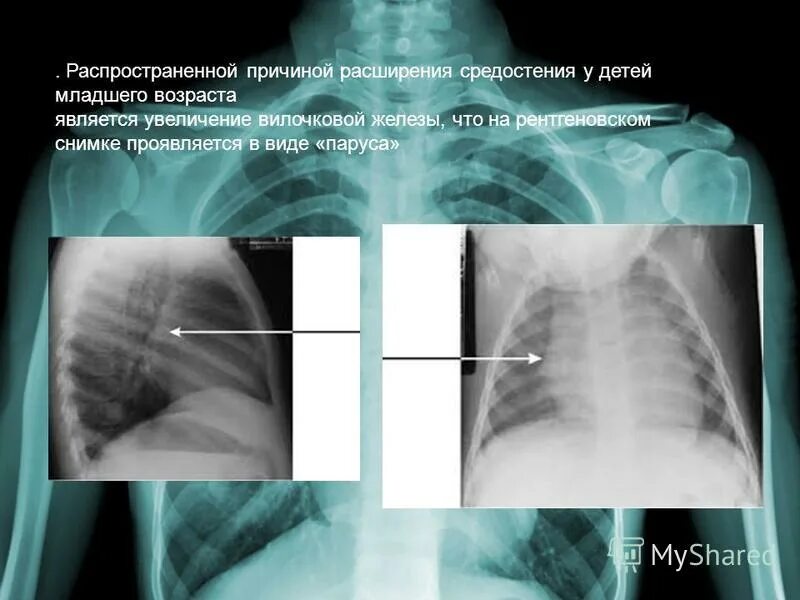 Расширение тени средостения. Расширение средостения вправо на рентгене. Расширение верхнего средостения на рентгене. Анатомия средостения рентген. Расширение верхнего средостения на рентгене описание.