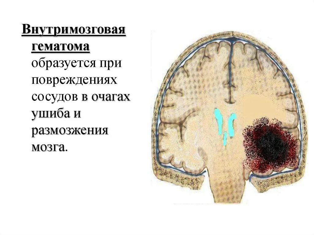 Гематома в головном мозге. Внутримозговая гематома. Локализации внутримозговых гематом. Внутримозговая гематома мозга.