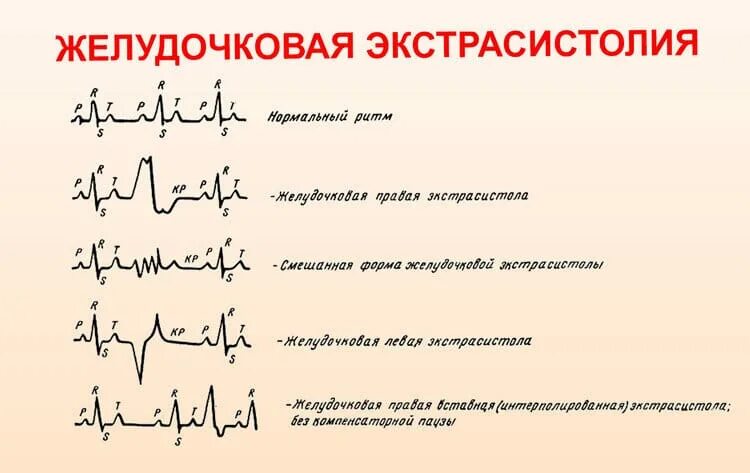 Нарушение ритма по типу экстрасистолии. Нарушения ритма на экг экстрасистолы. экстрасистола желудочков на экг. аритмия и экстрасистолия на экг. желудочковая экстрасистолия на экг.