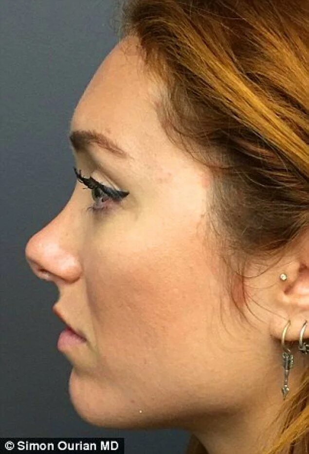 Лицо девушки в профиль. Нос человека курносый. Нос человека курносый. Ринопластика курносого носа. Нос человека курносый.