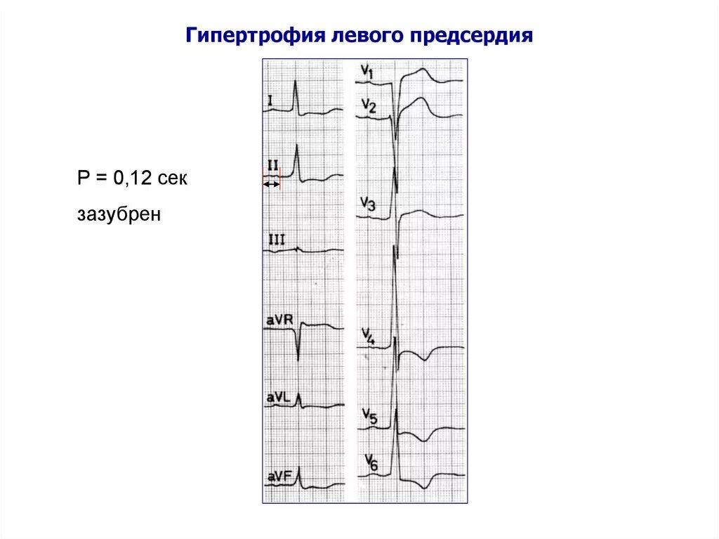 Гипертрофия левого предсердия на ЭКГ. Признаки гипертрофии предсердий на ЭКГ. Гипертрофия предсердий на ЭКГ. ЭКГ при гипертрофии предсердий. Гипертрофия левого предсердия левого желудочка