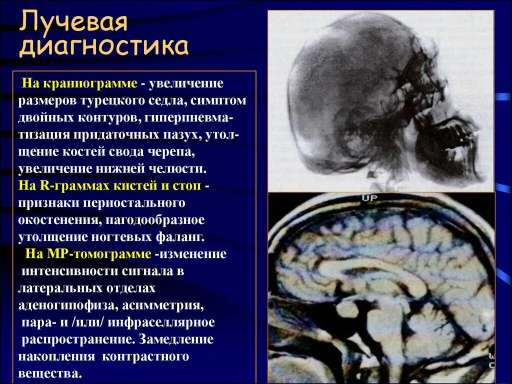 Симптом турецкого седла. Симптом двойного контура. Лучевая диагностика турецкого седла. Акромегалия лучевая диагностика. Увеличенное турецкое седло.