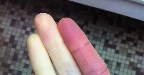 Почему пальцы на руках холодные