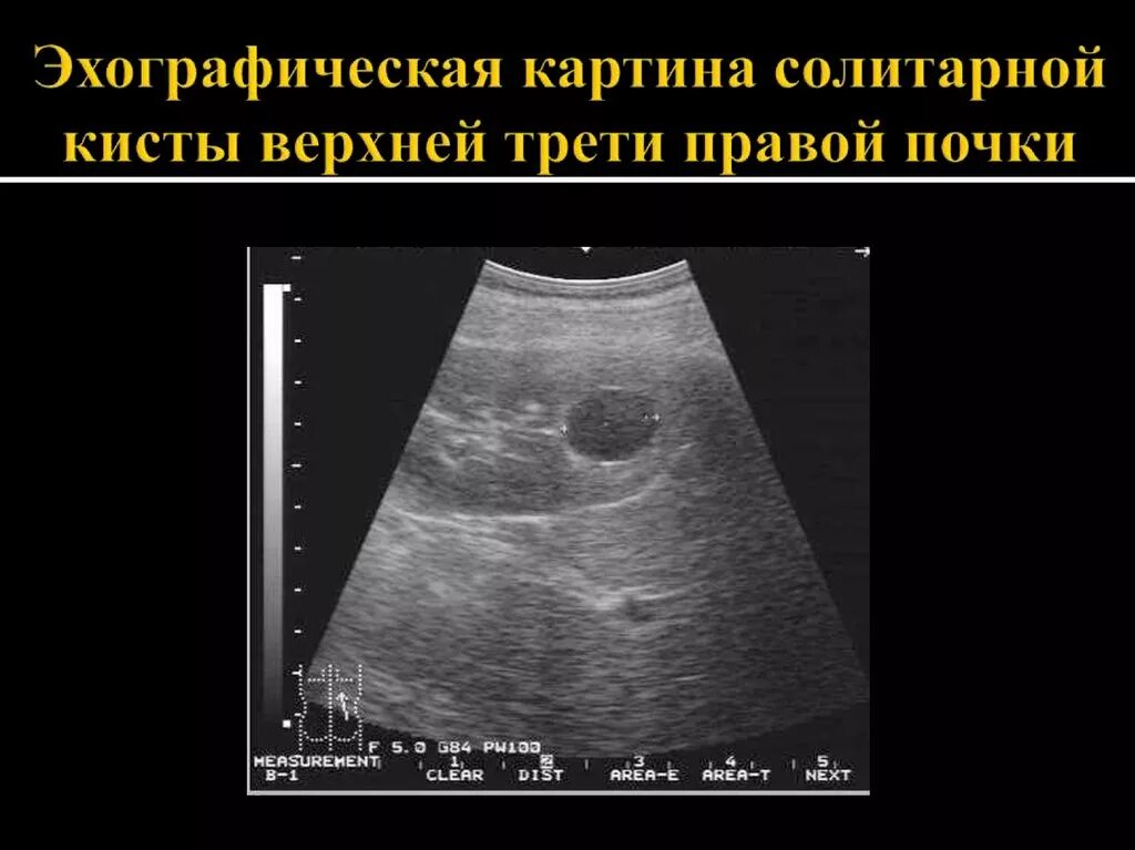 Киста в почке лечение у взрослых женщин. Солитарная киста почки УЗИ. Солитарная киста почки снимок. Образование левой почки на УЗИ.