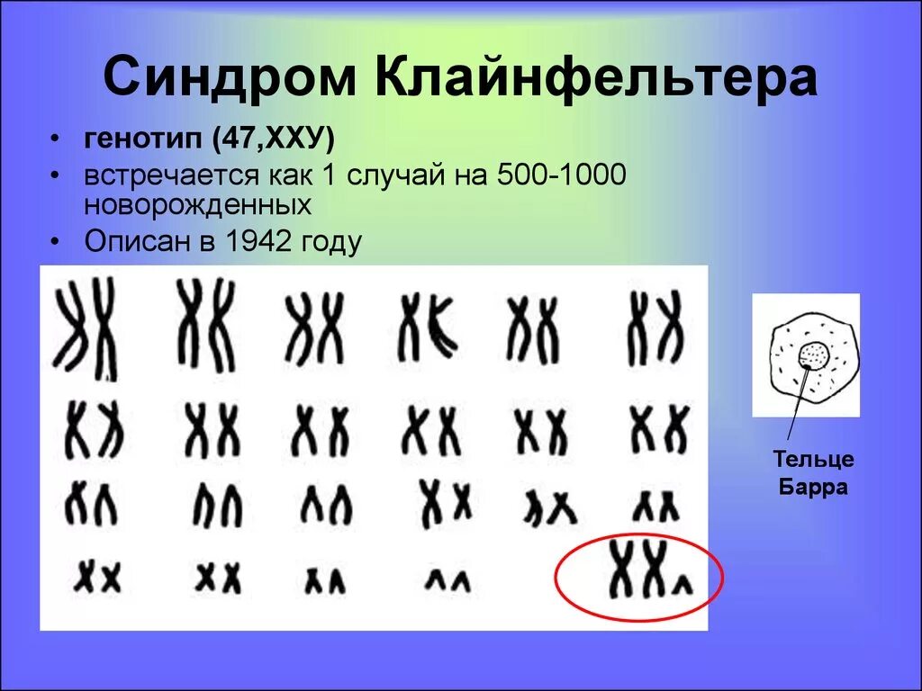 Отсутствие х хромосомы у мужчин. Синдром Клайнфельтера кариотип. Синдром Клайнфельтера кариограмма. Формула кариотипа при синдроме Клайнфельтера.