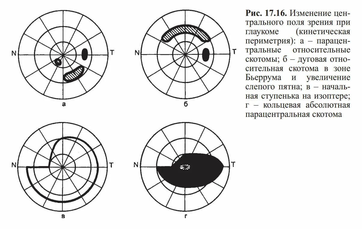 Поля зрения при глаукоме периметрия. Скотома Бьеррума. Центральные скотомы в поле зрения. Поля зрения абсолютная скотома. Центральное поле зрения