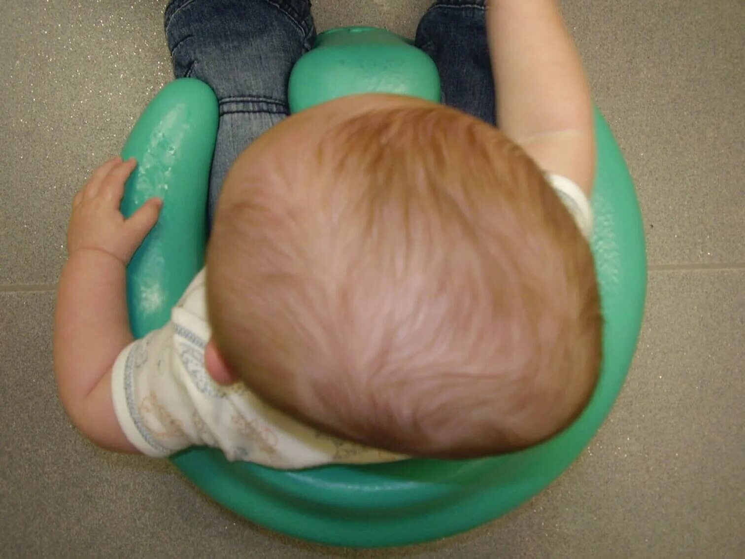 Синостоз плагиоцефалия. Плагиоцефалия средней степени. Синостоз плагиоцефалия. Краниосиностоз плагиоцефалия. Тригоноцефалия – деформация черепа.