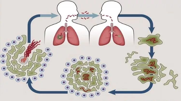 Воздушно капельный путь заражения туберкулезом. Механизм заражения туберкулезом схема. Пути передачи заражения туберкулезом. Туберкулёз пути передачи инфекции.