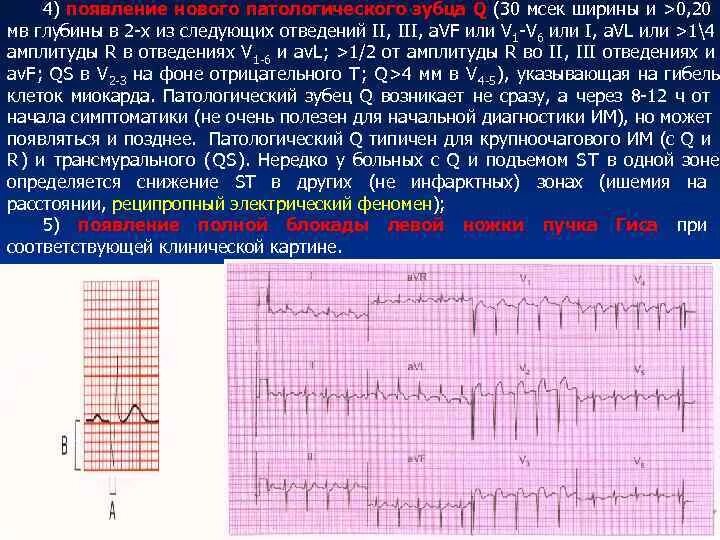 Изменение зубца q. Зубец q II III AVF. Зубец q в 3 отведении на ЭКГ И AVF. Отрицательный зубец q в 3 отведении на ЭКГ И AVF. Зубец q во 2-3 отведения и AVF.