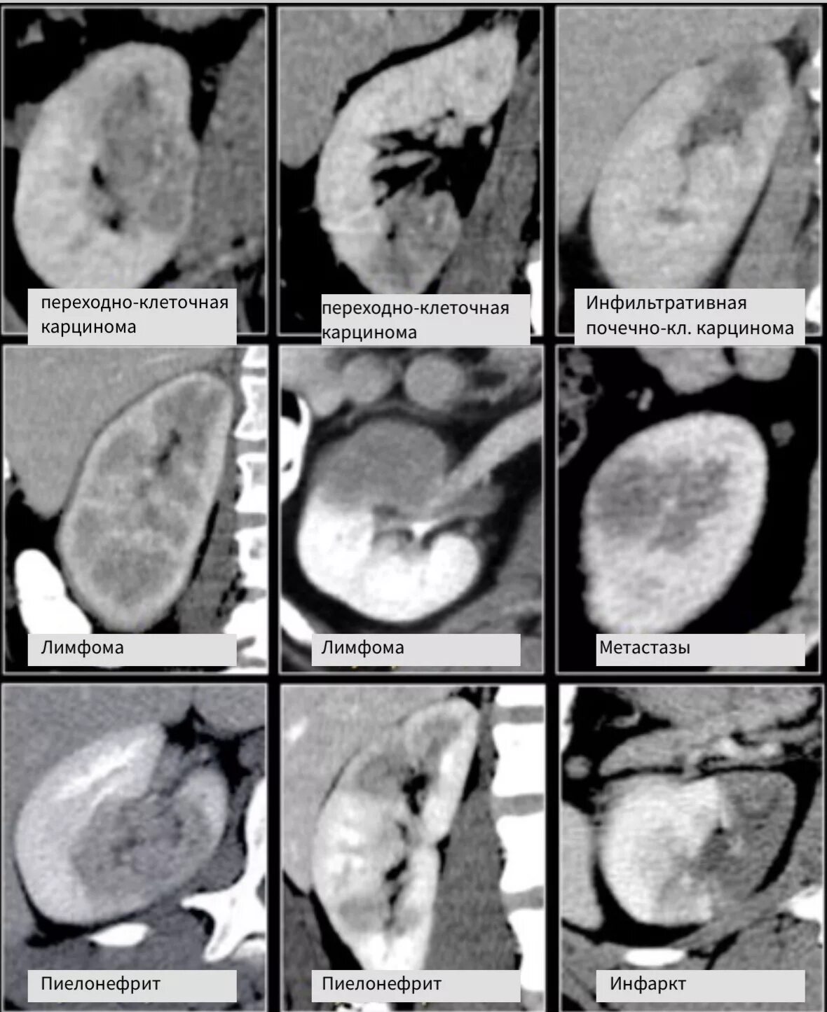 Кистозно-Солидное образование почки мрт. Переходно-клеточная карцинома почек кт. Гиперденсное образование почки на кт. Кистозно-Солидное образование почки кт. Гиподенсивное образование в печени